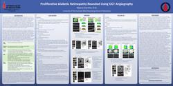 Proliferative Diabetic Retinopathy using OCT Angiography